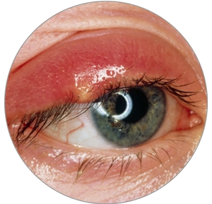 Conjunctivitis